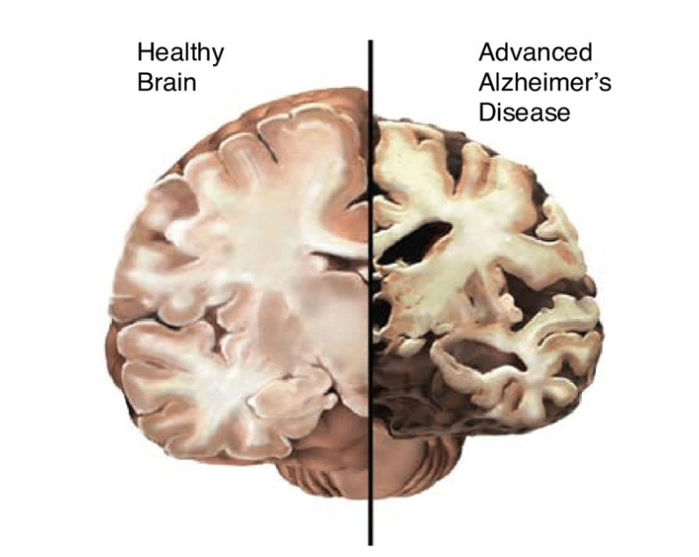 The brain of an Alzheimer's patient Compare the brain of a normal person(Source - https://www.researchgate.net/figure/The-Healthy-Brain-left-and-the-Alzheimers-Brain-right_fig1_5261932)